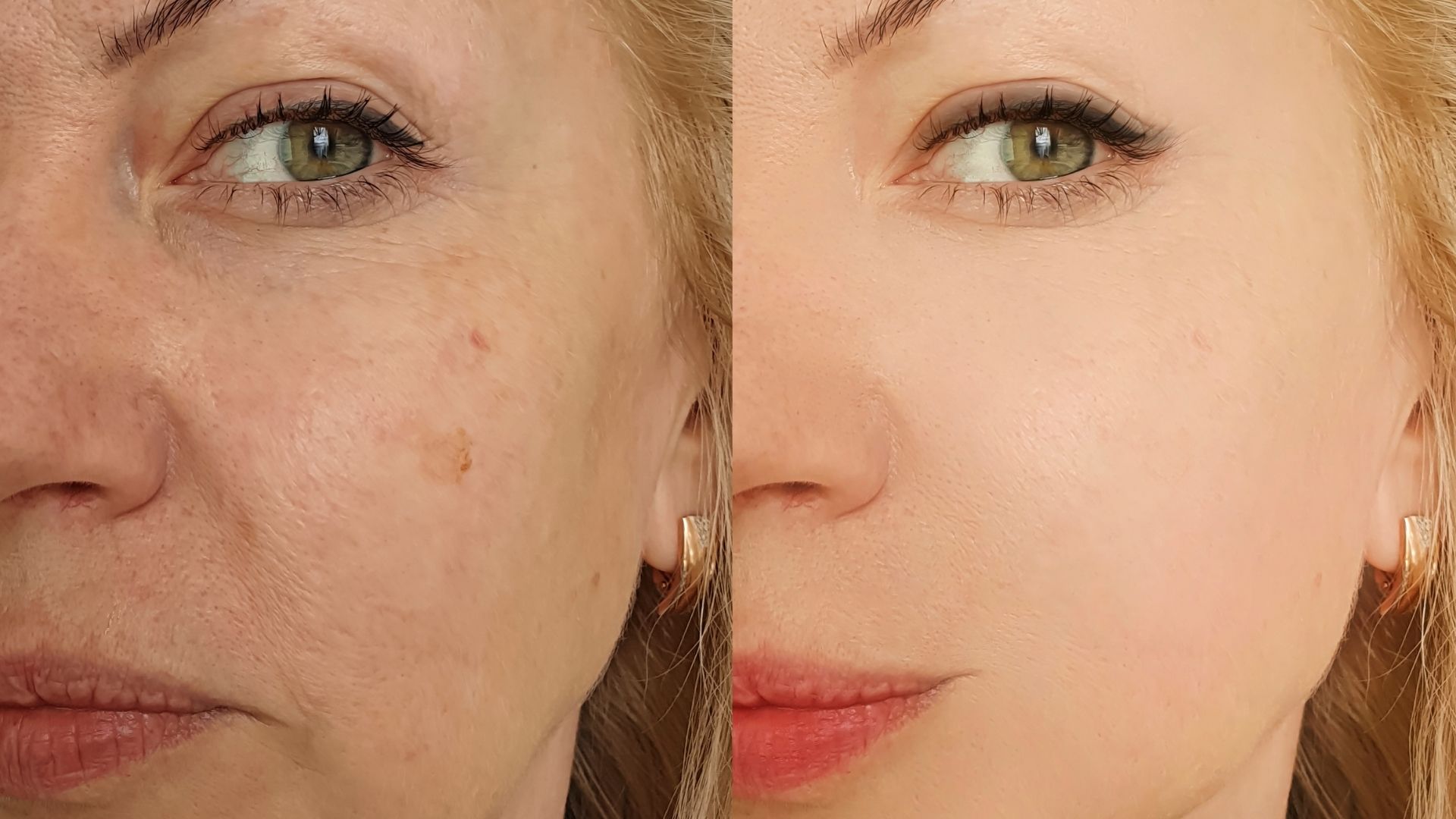 scarless-facelift-turkey-before-after-1 scarless-facelift-turkey-before-after-1 in turkey, antalya