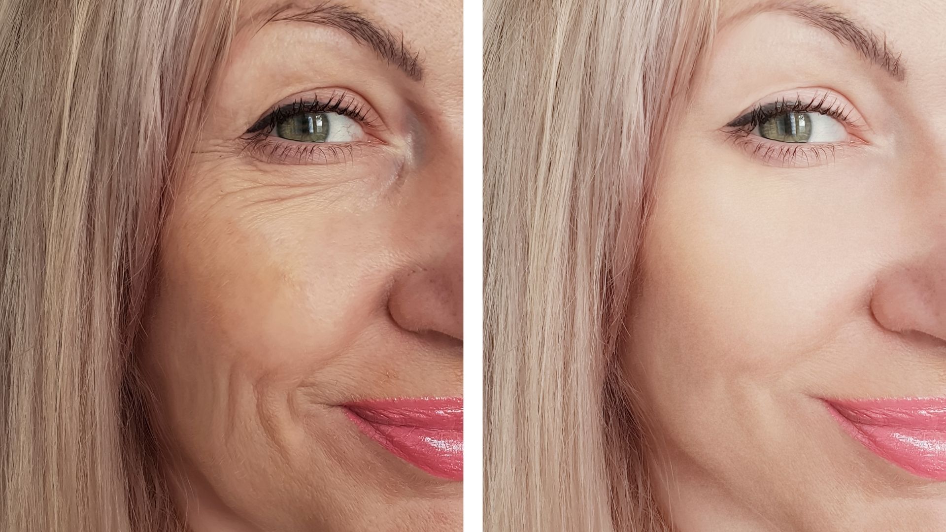 scarless-facelift-turkey-before-after-2 scarless-facelift-turkey-before-after-2 in turkey, antalya