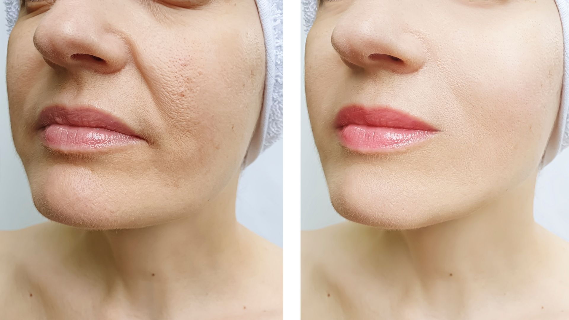 scarless-facelift-turkey-before-after-4 scarless-facelift-turkey-before-after-4 in turkey, antalya