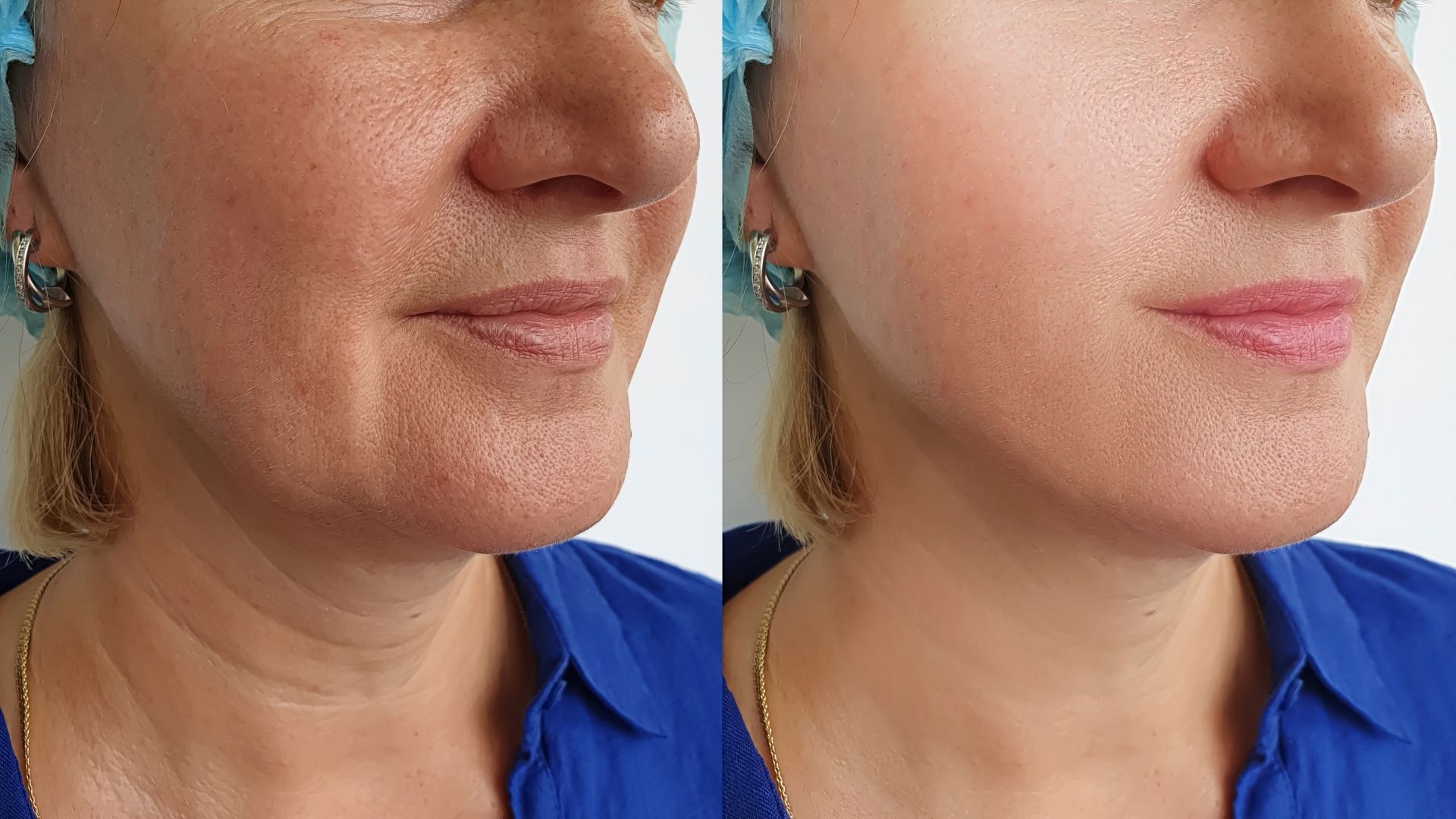 scarless-facelift-turkey-before-after-5 scarless-facelift-turkey-before-after-5 in turkey, antalya