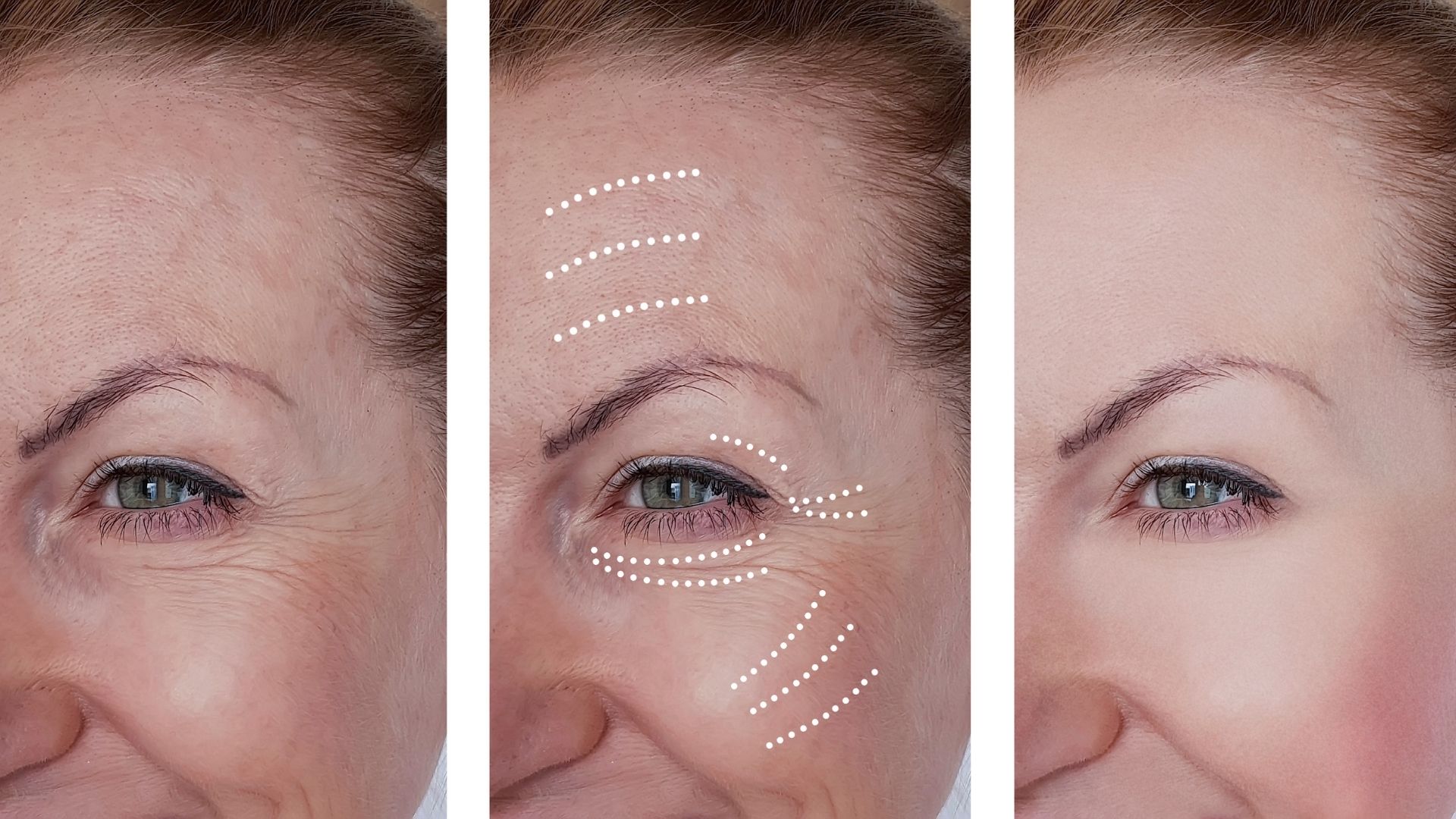 temporal-midface-lift-turkey-before-after-1 temporal-midface-lift-turkey-before-after-1