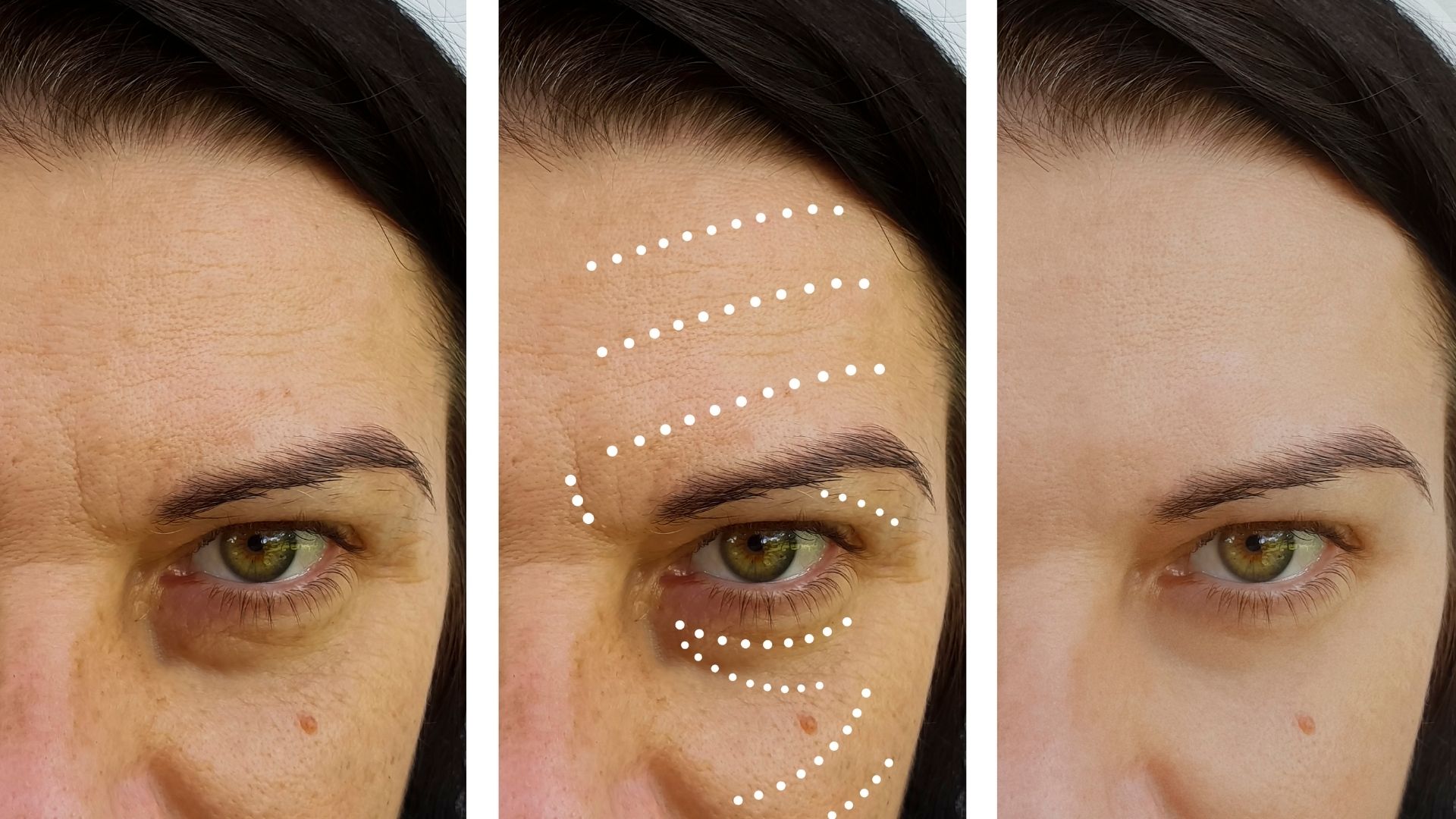 temporal-midface-lift-turkey-before-after-2 temporal-midface-lift-turkey-before-after-2